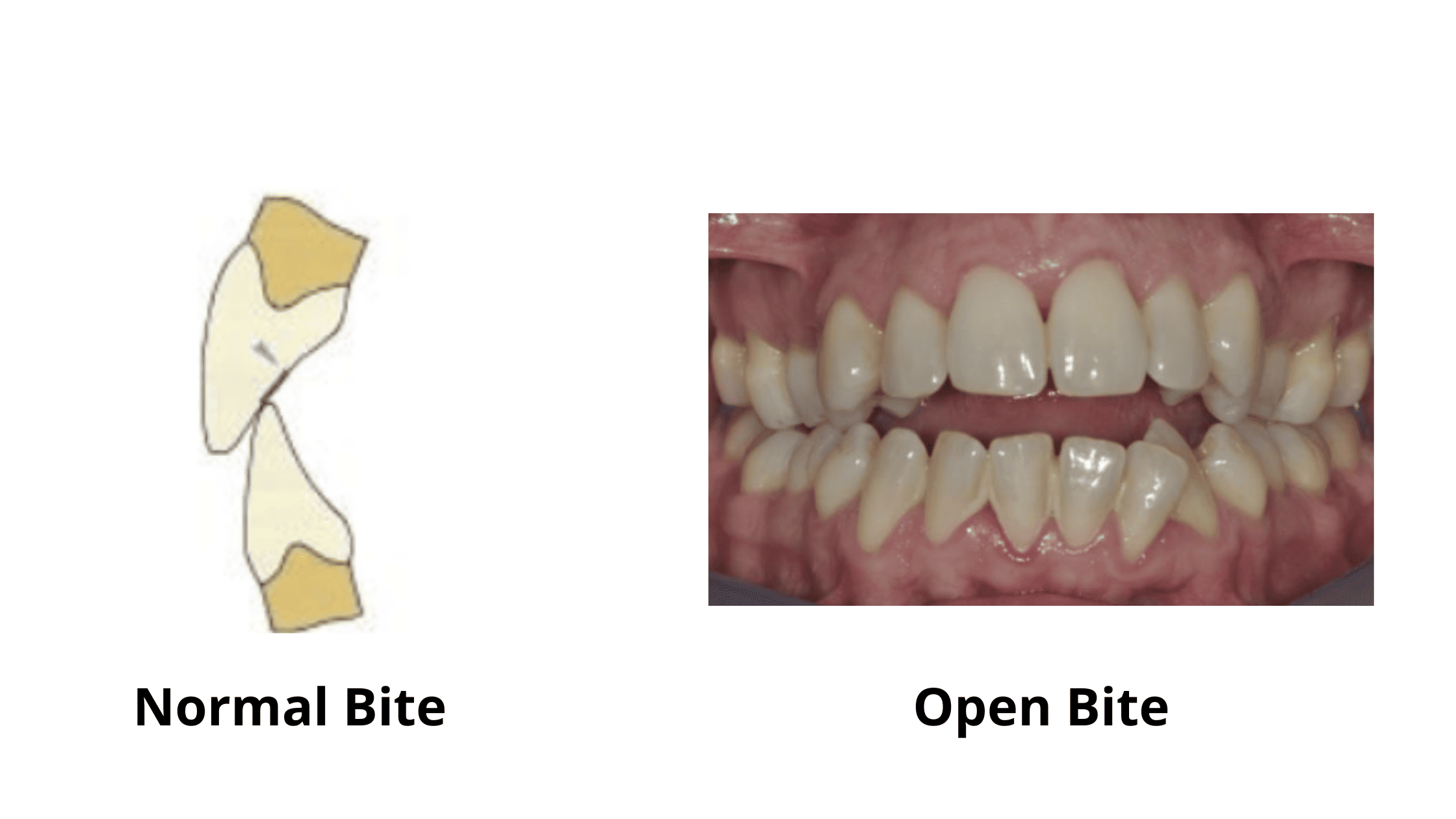 Normal bite vs Open bite