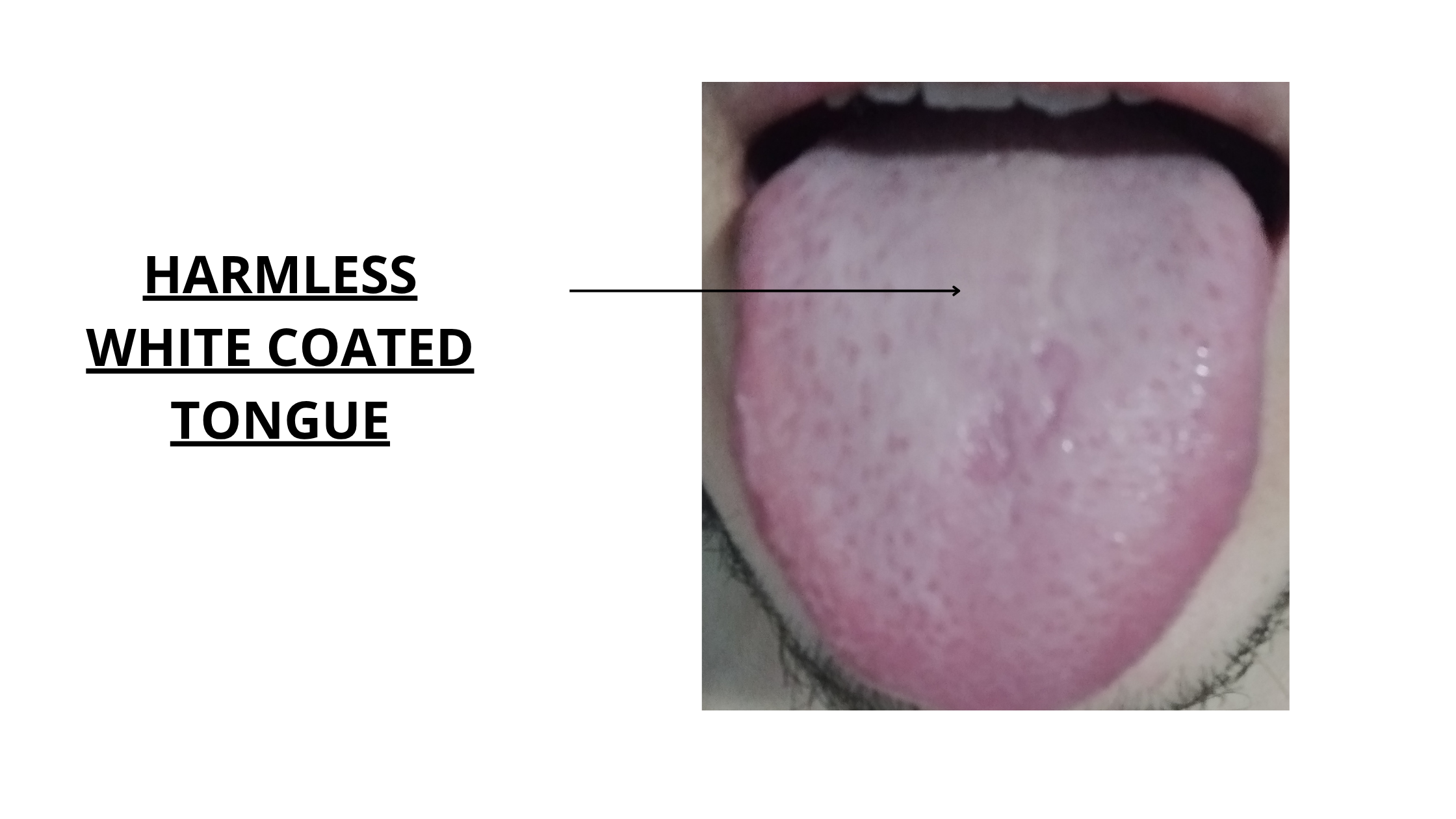 Image of normal and harmless white tongue coating