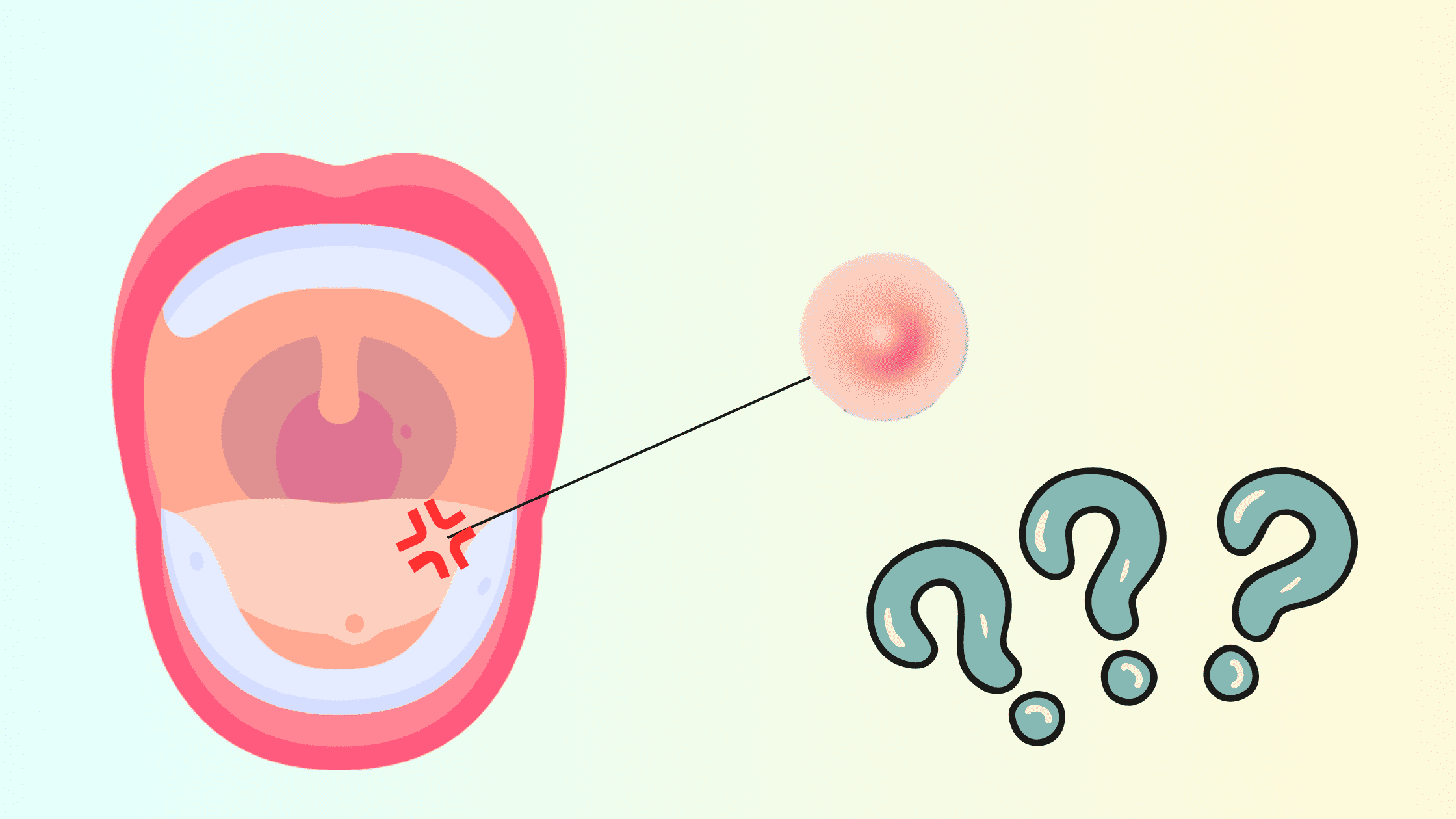 Oral Fibroma