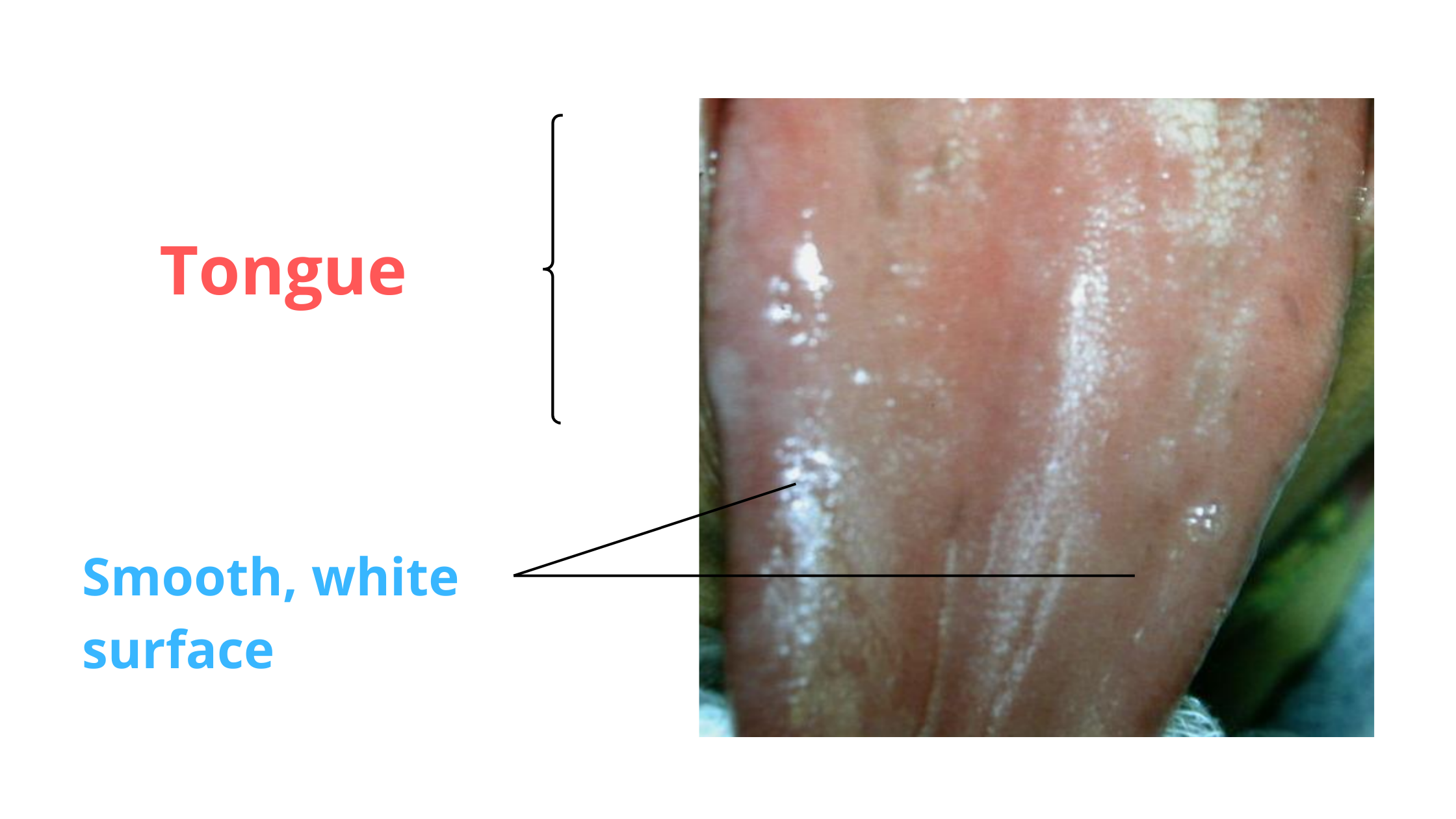 clinical image of oral lichen planus on the tongue