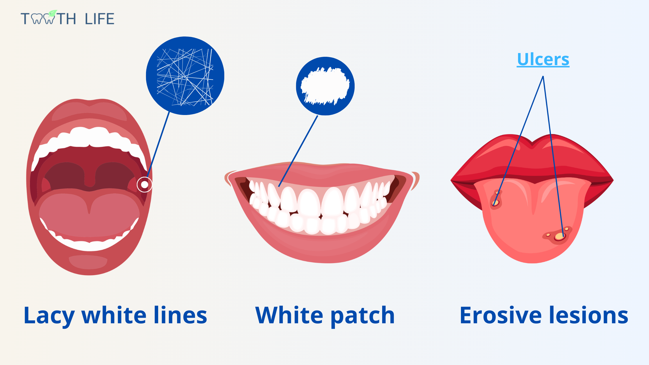 The three most common types of oral lichen planus: reticular, erosive and plaque.