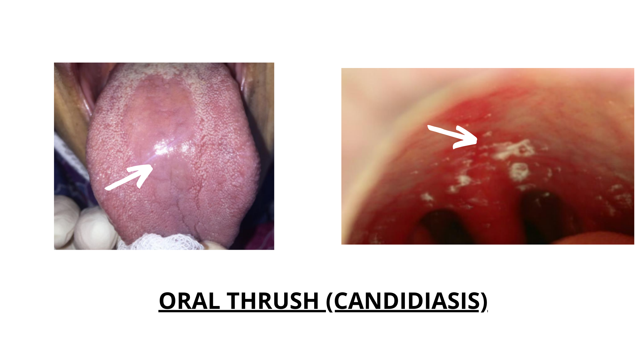 Oral thrush cases