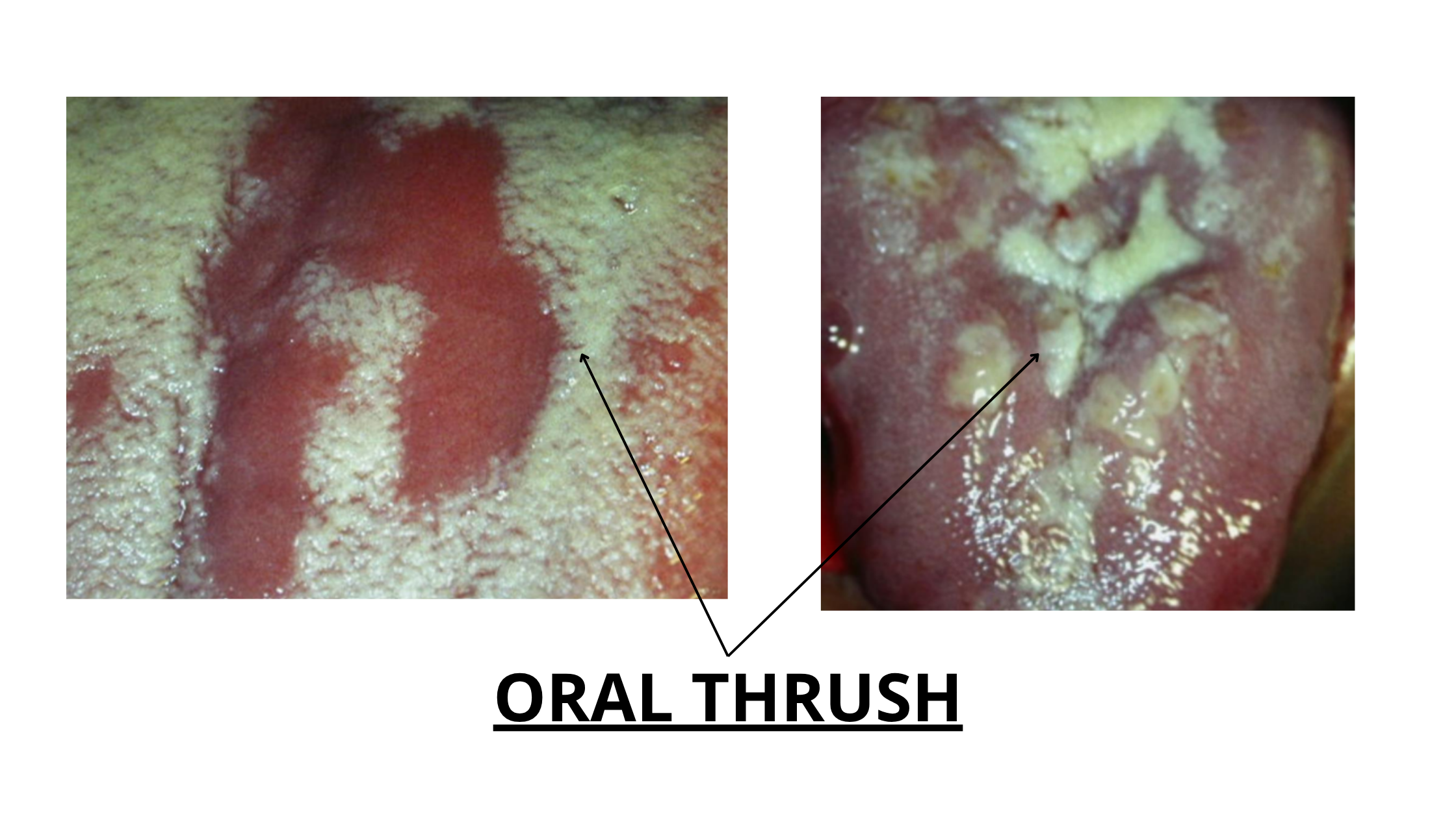 clinical images of oral thrush on the tongue