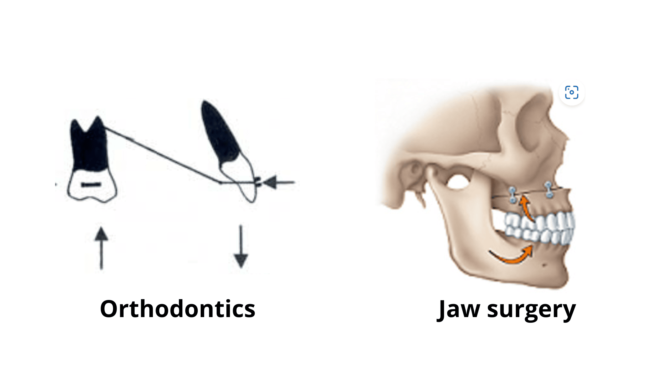 orthodontic and jaw surgery to fix an open bite