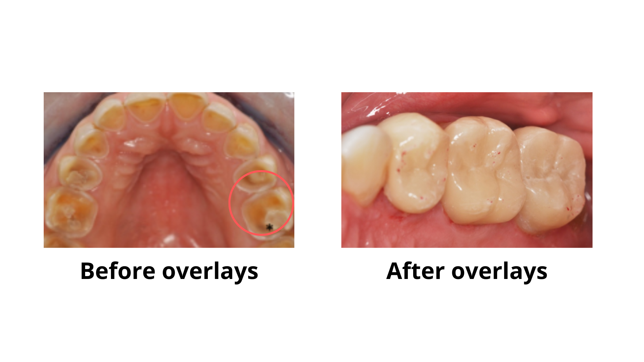 overlays for worn down back teeth: Restoring the chewing surfaces