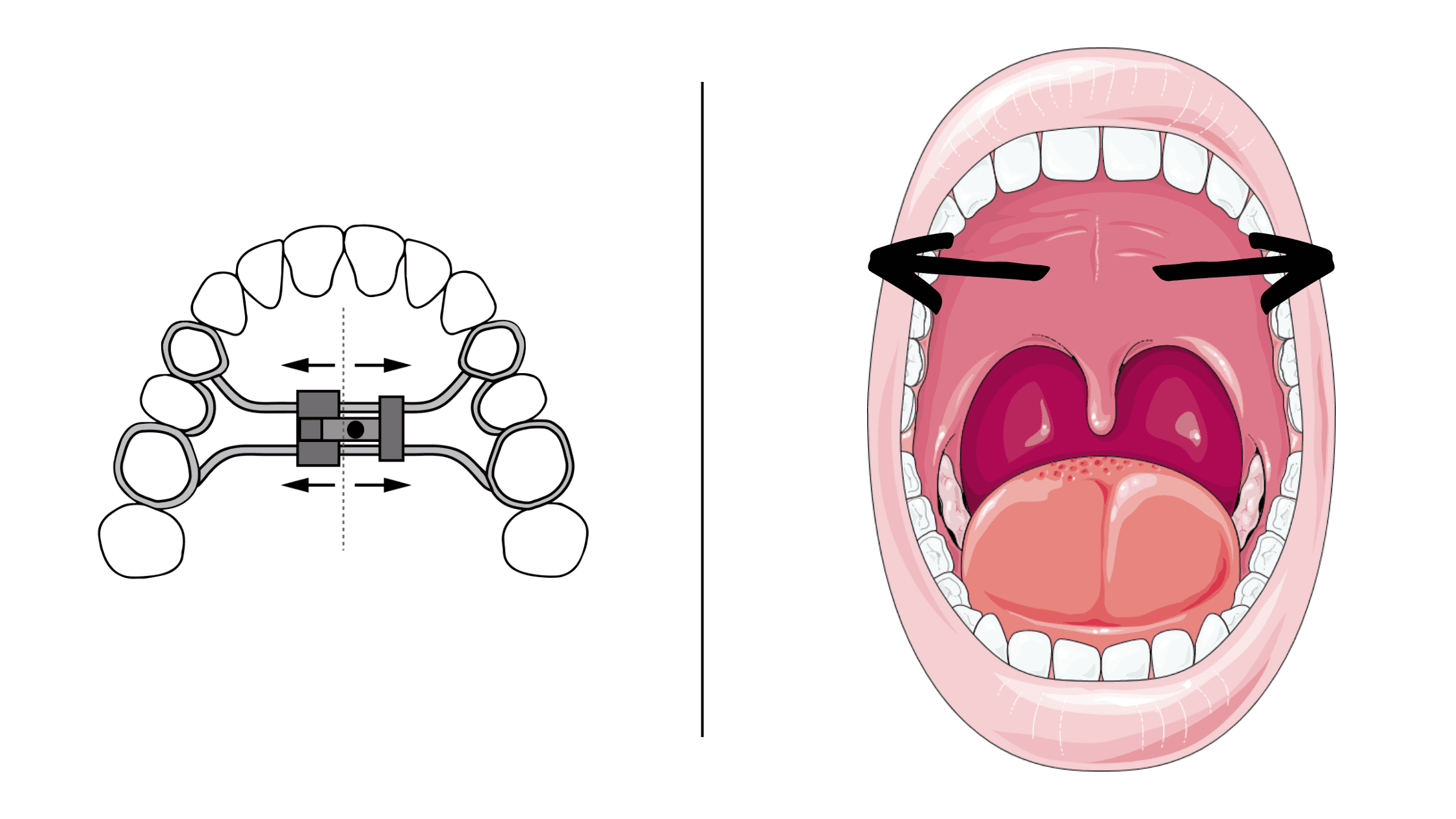 Palatal expander stimulating the growth of the upper jaw