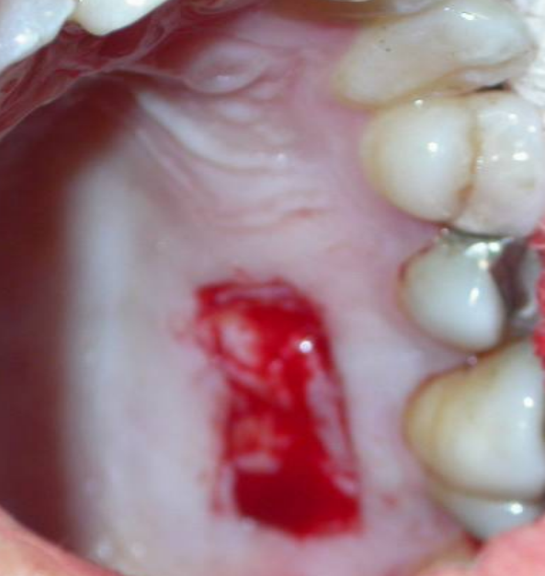 roof of the mouth after free gingival graft technique