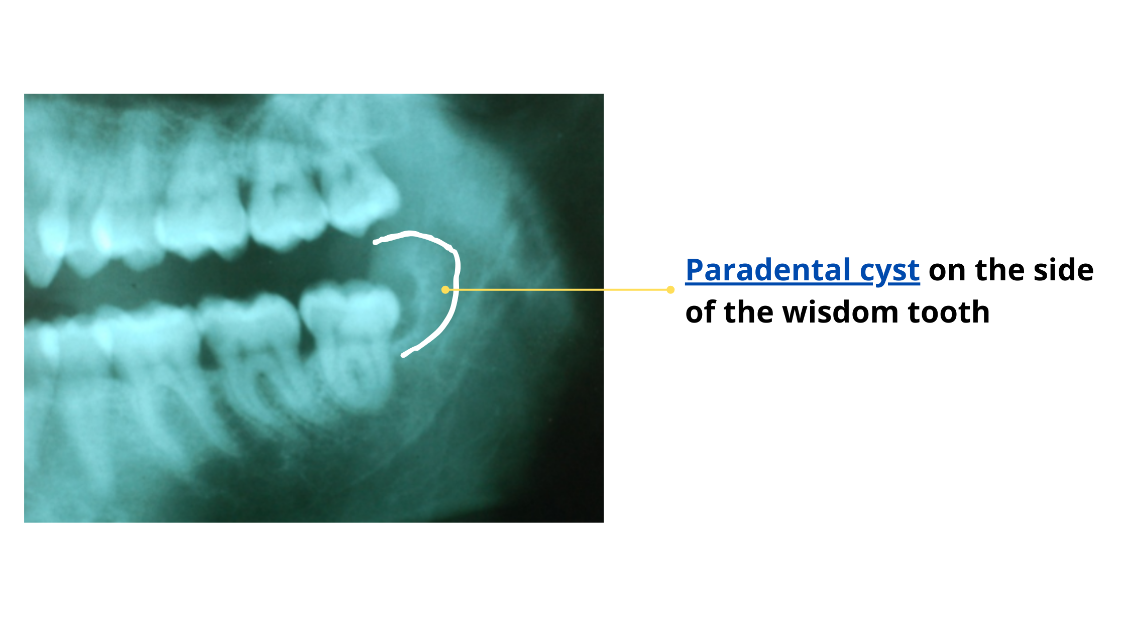 dental X-ray image of paradental cyst