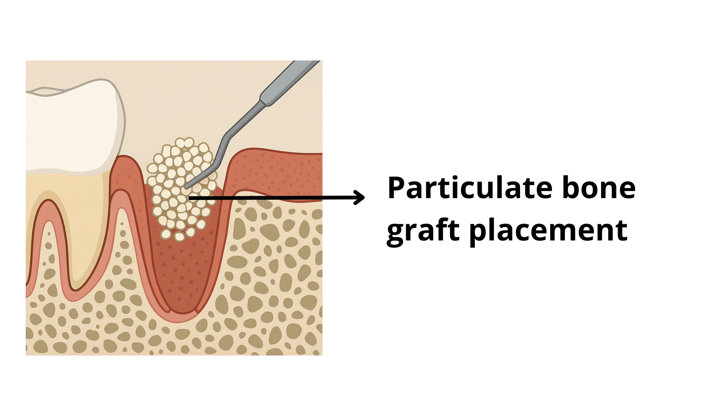 Particulate bone graft placement after tooth extraction