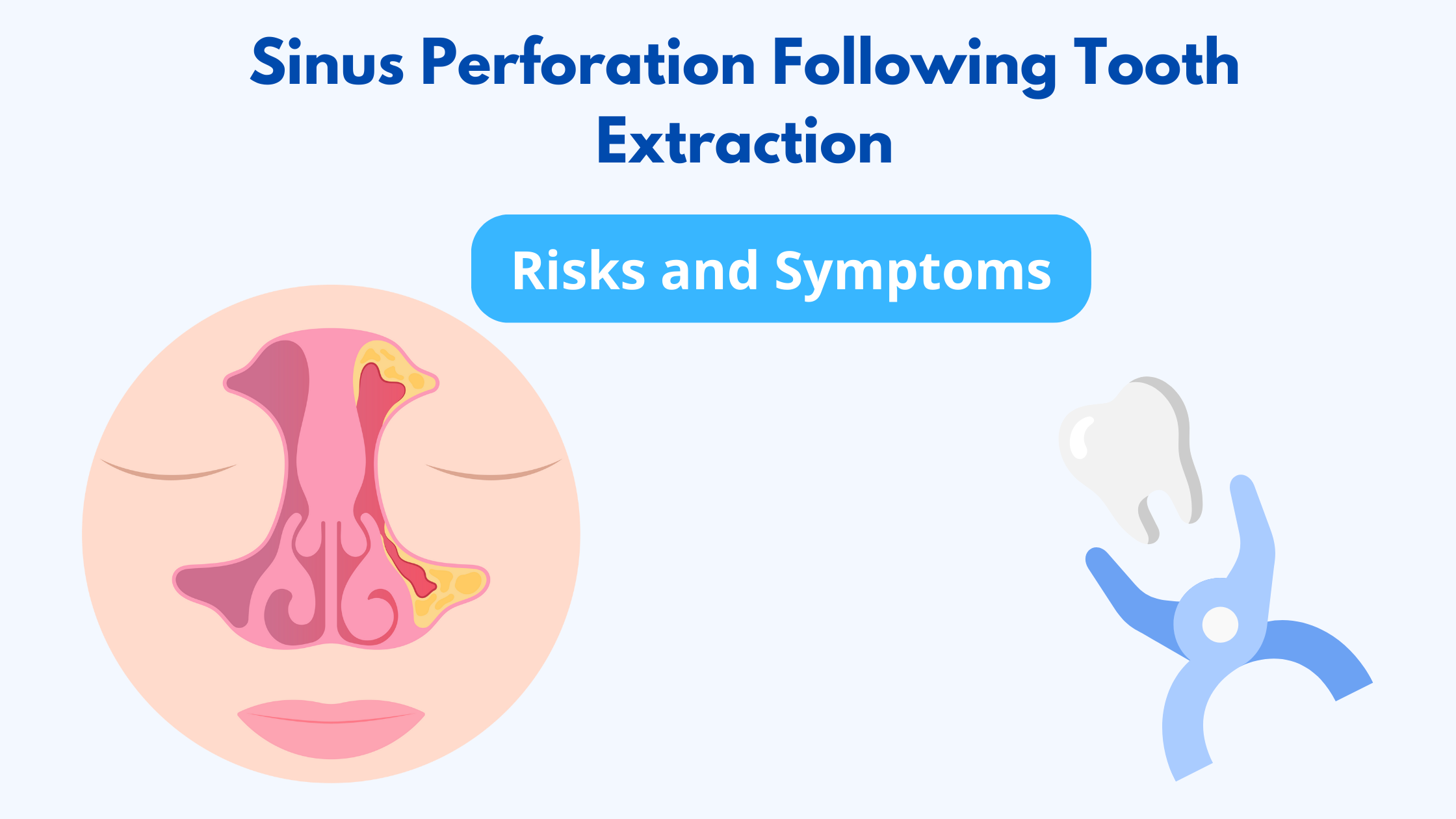 Sinus perforation after tooth extraction: Symptoms and Risk