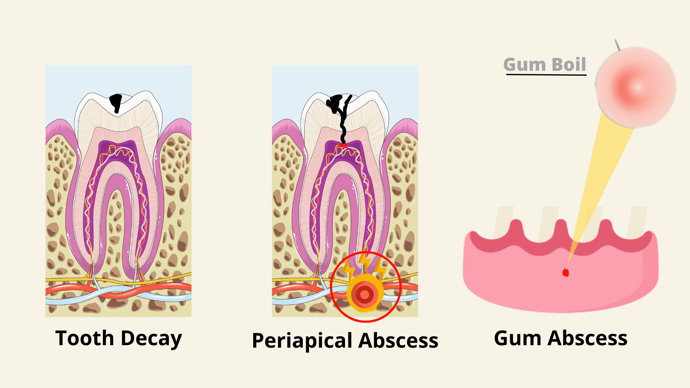 the stages of periapical abscess