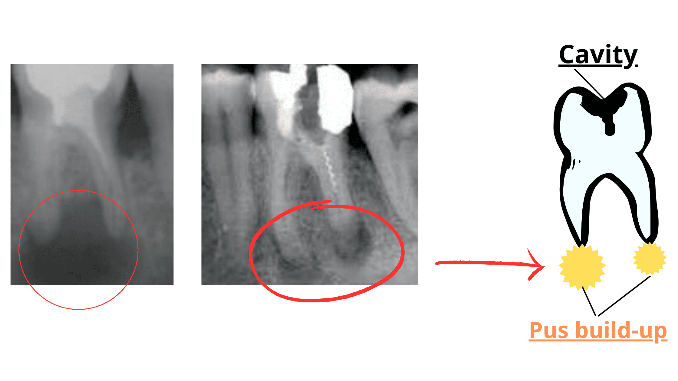 Dental abscess on X-rays