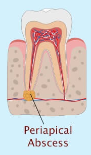periapical abscess