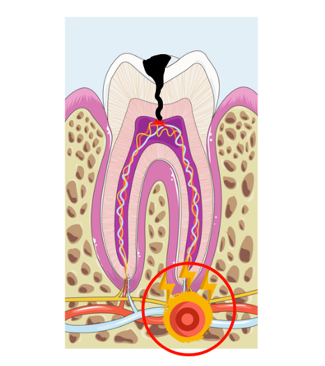 periapical periodontitis due to a cavity