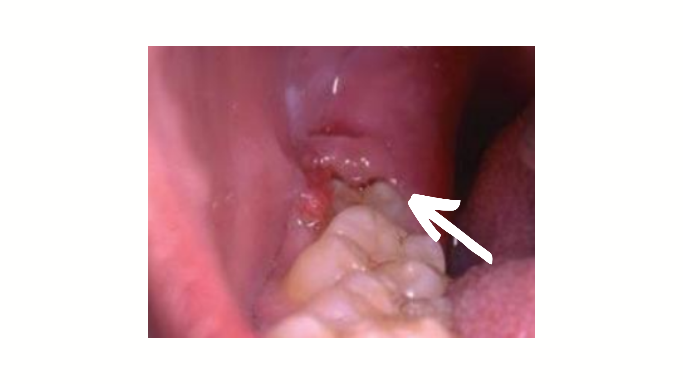Clinical image of pericoronal abscess