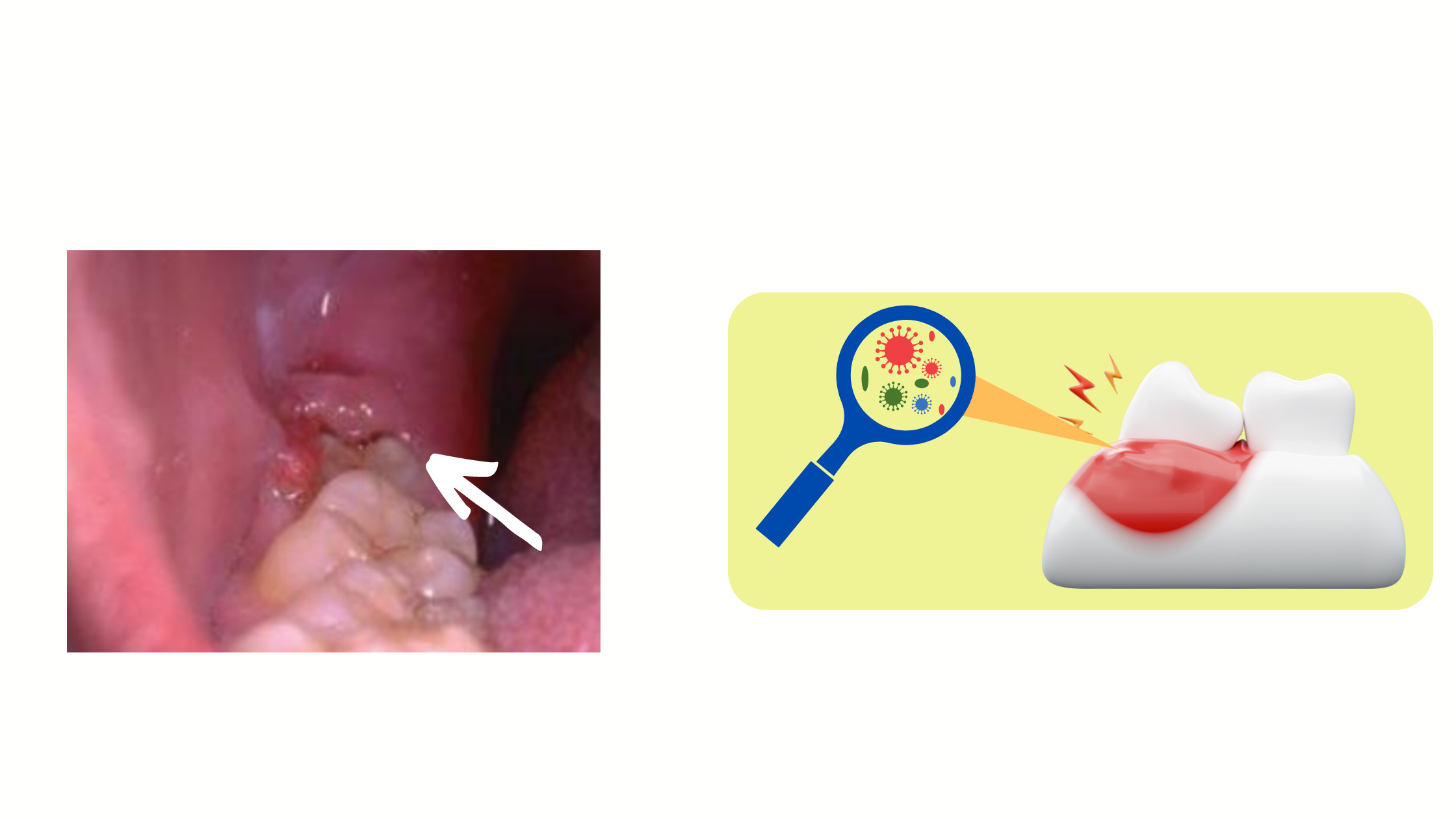 Pericoronitis: inflammation of the gums covering a partially erupted wisdom tooth