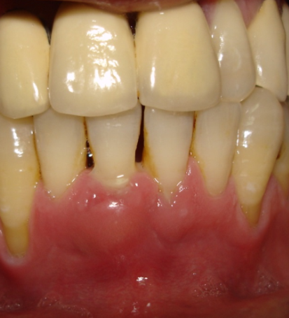 Clinical image of periodontal abscess