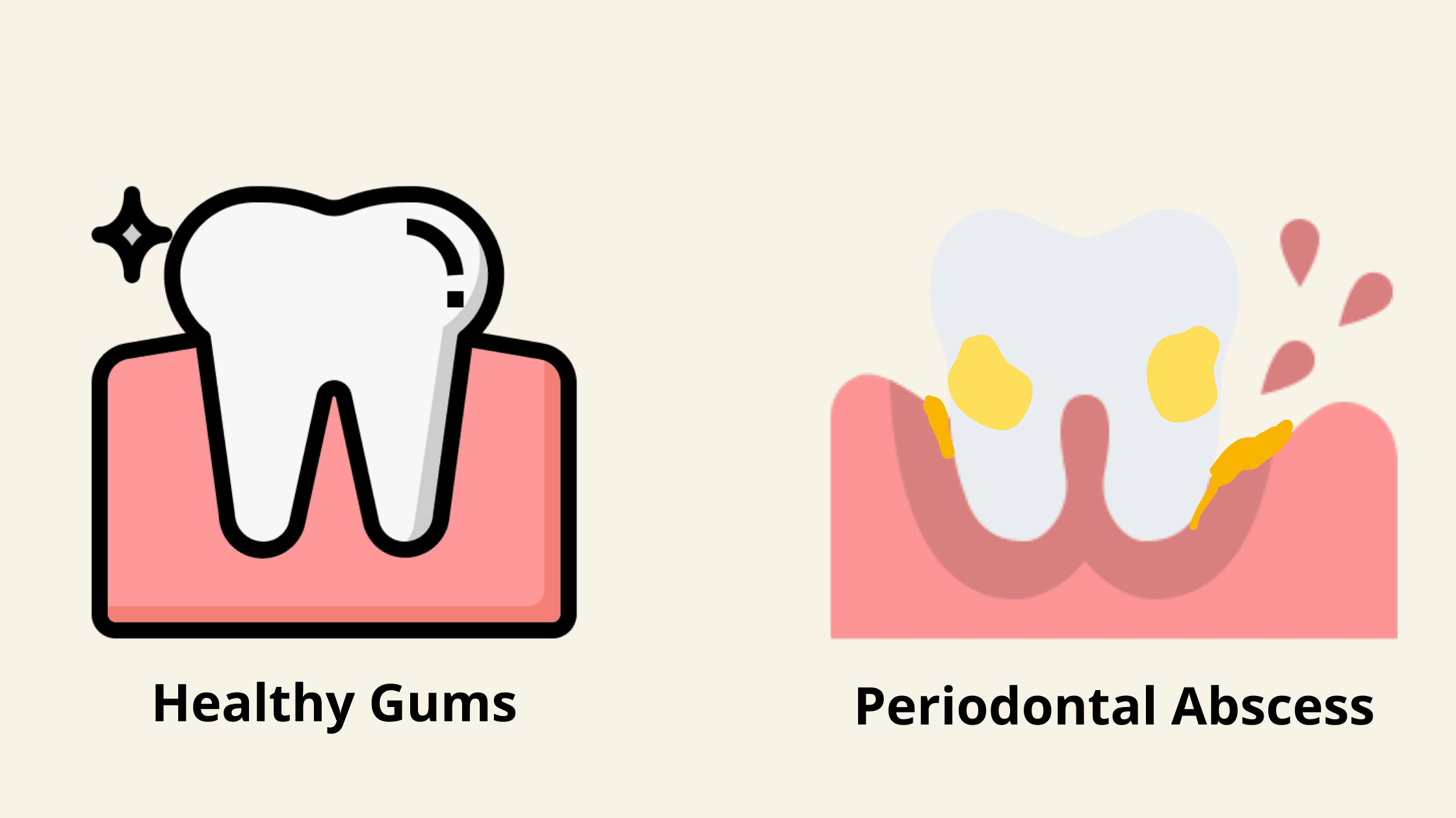 periodontal abscess stages