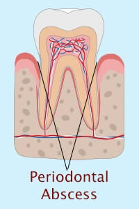 periodontal abscess
