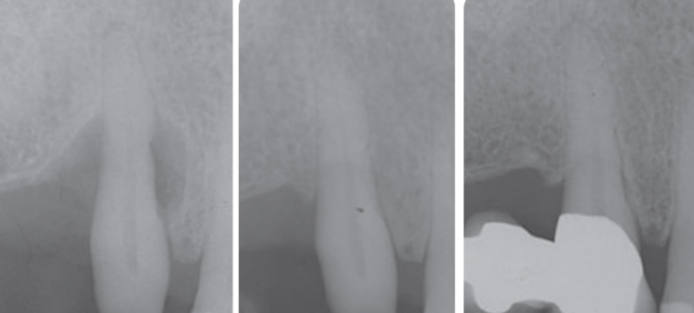 Periodontal bone graft before and after: X-ray image