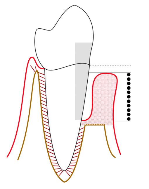 Periodontal disease where the gum and bone supporting the tooth are receded