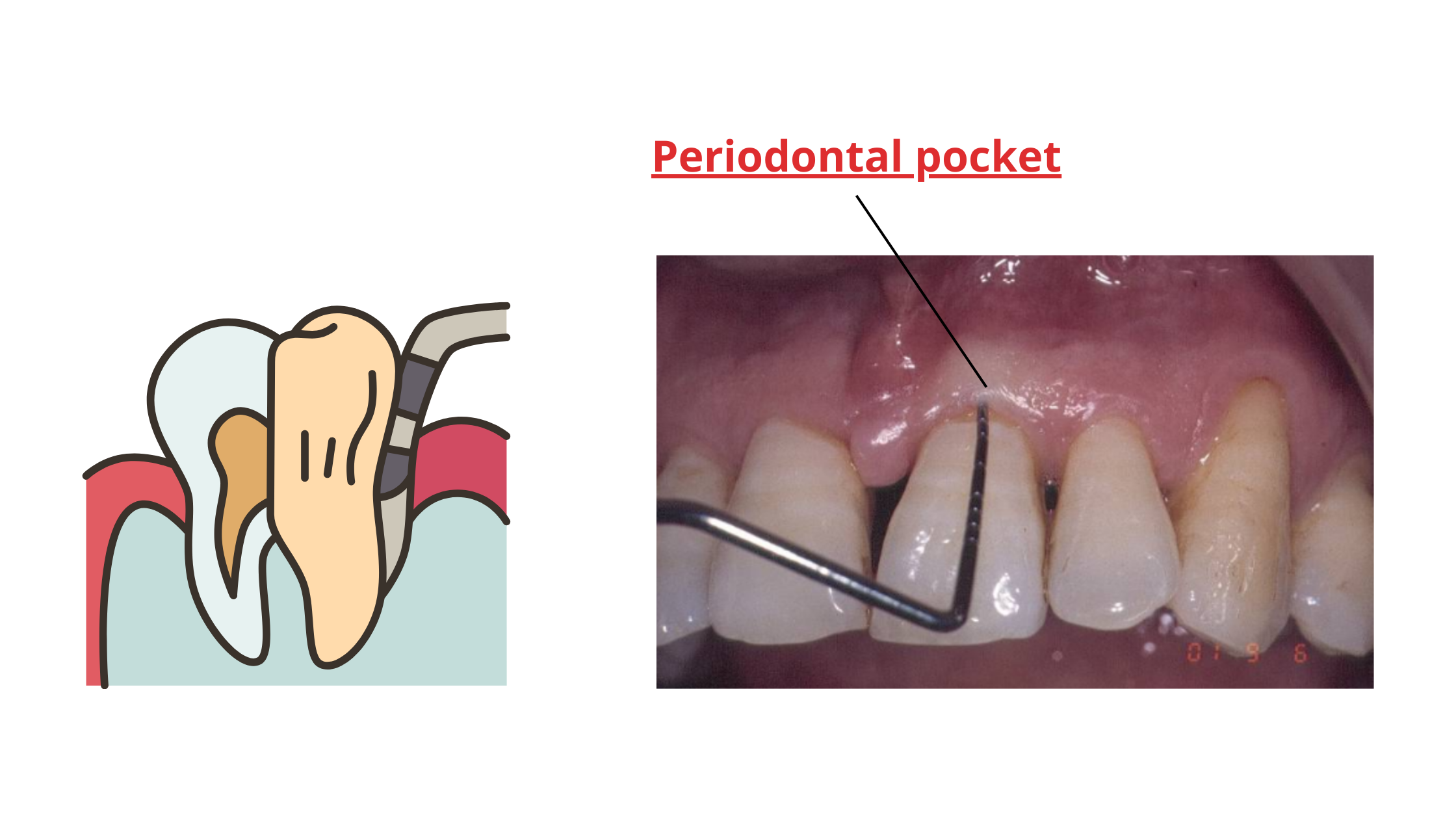 Periodontal pocket