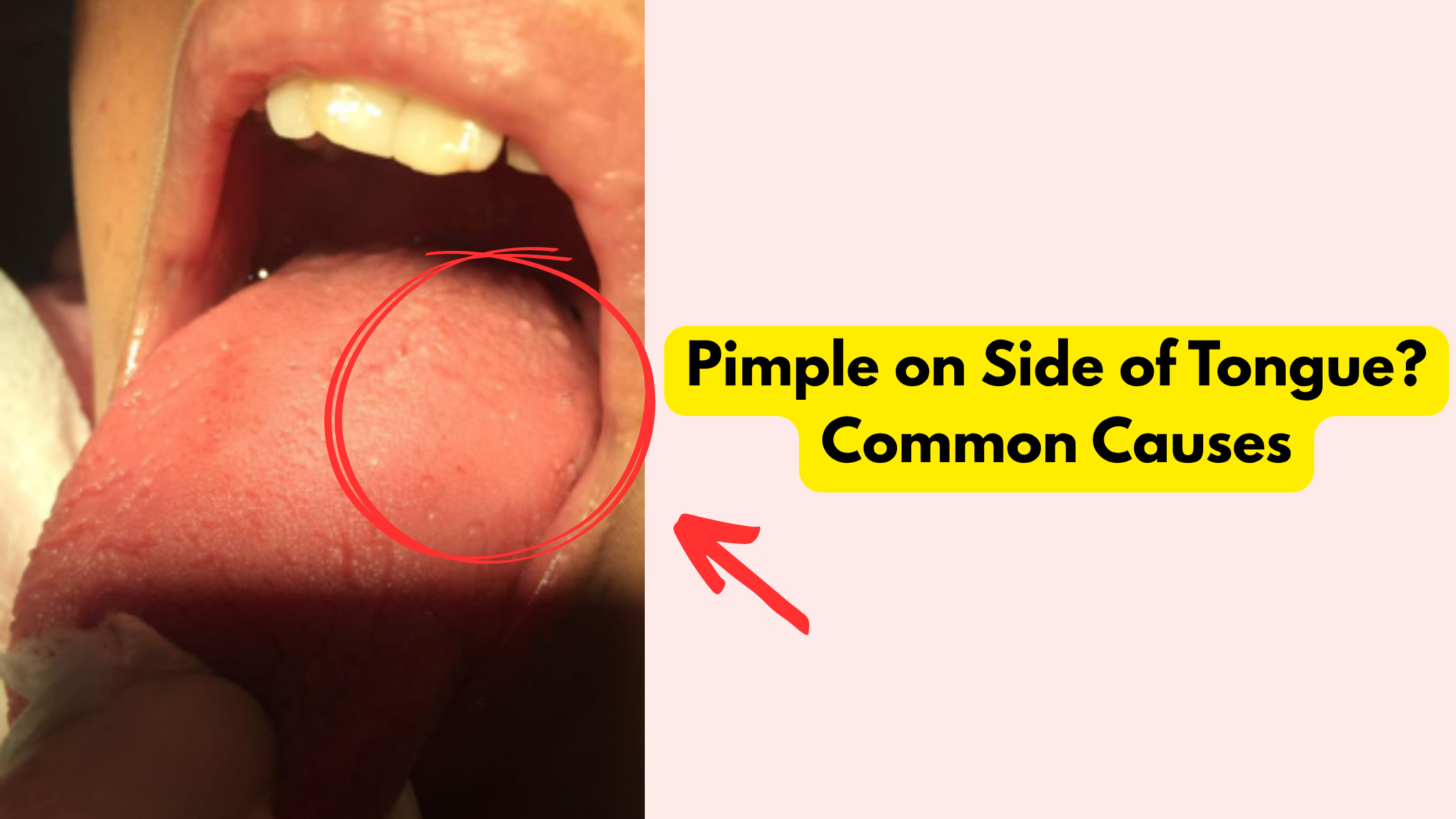 Pimple on side of tongue