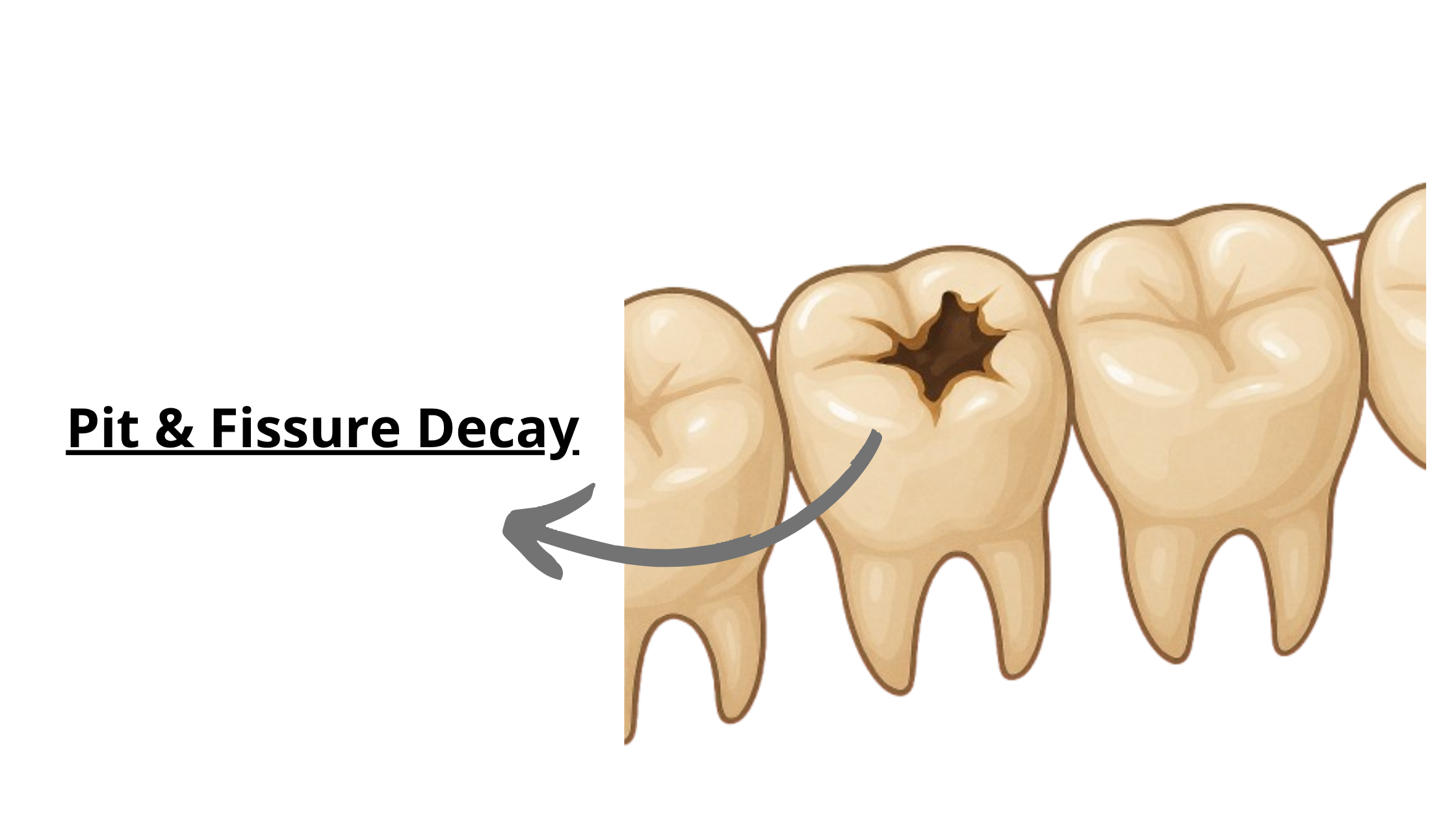 pit and fissure cavity