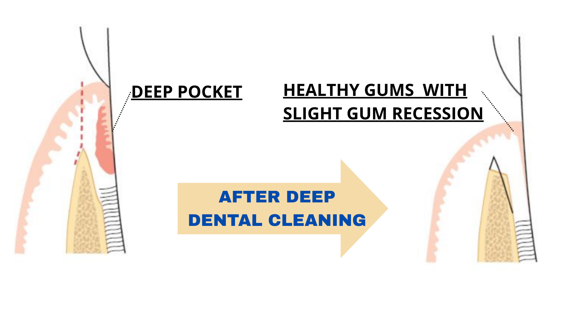 Pocket depth reduction after deep dental cleaning