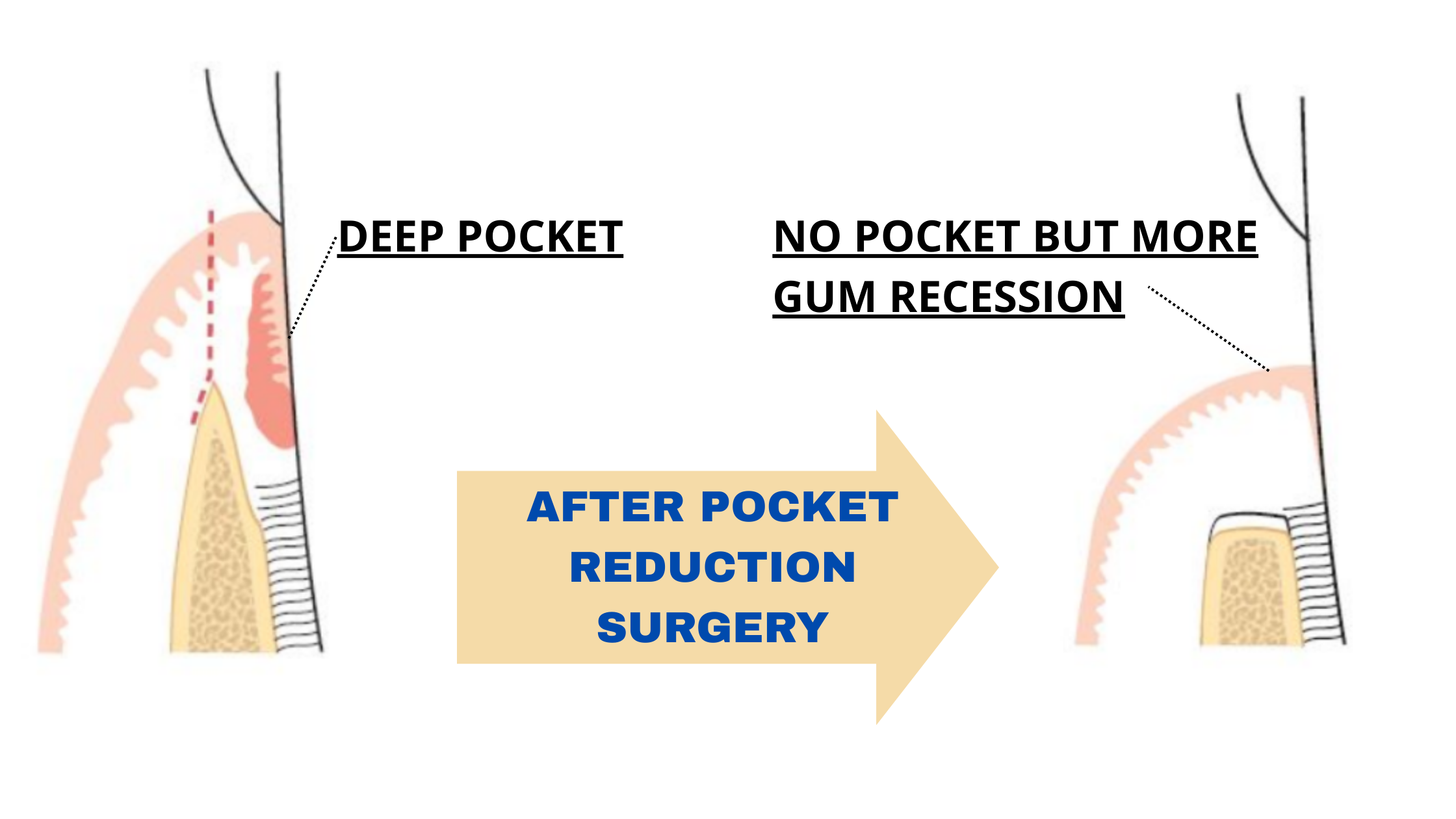 Pocket reduction after pocket surgery