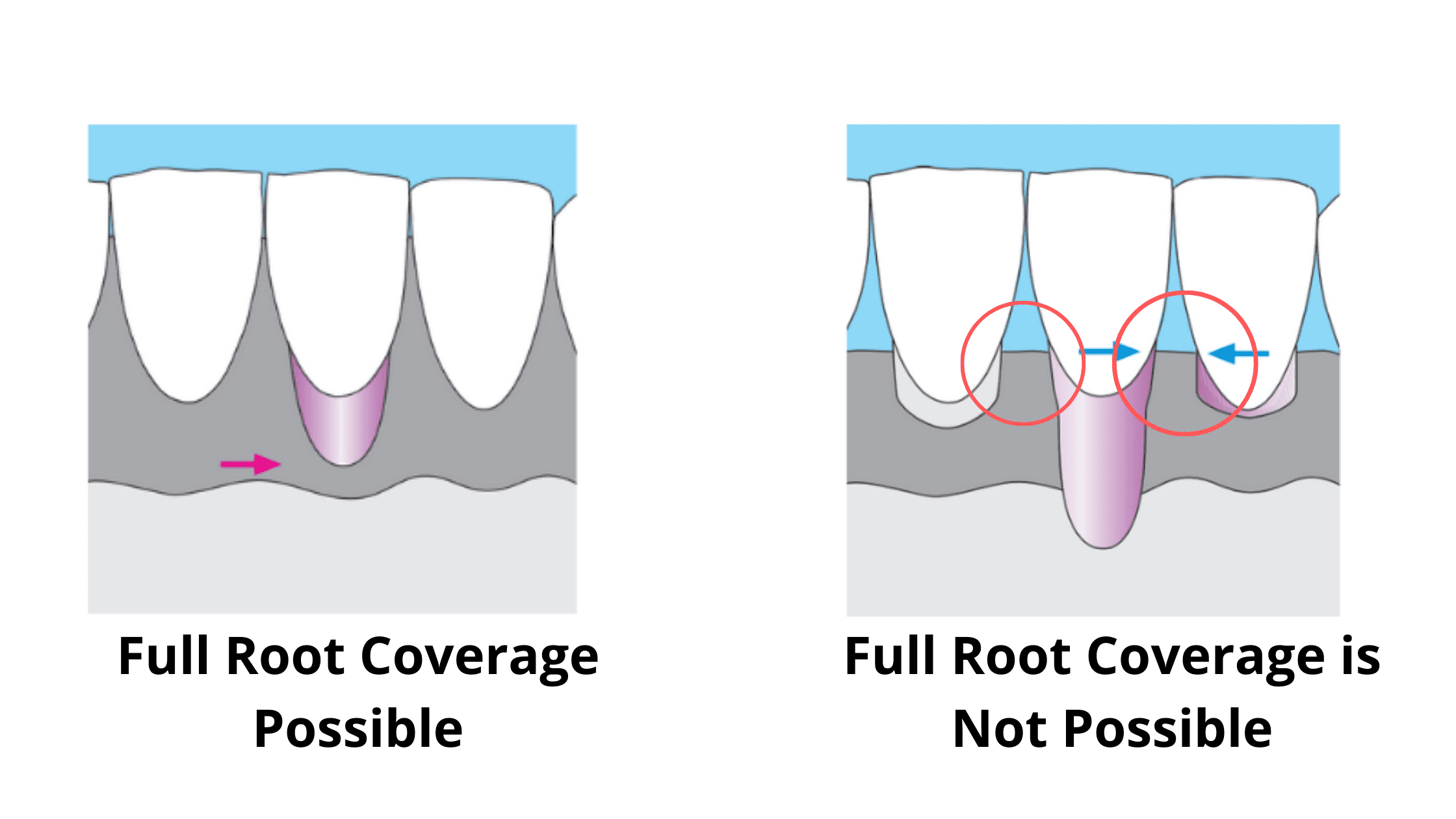 Two figures showing gingival recession. Complete root coverage is possible when the recession does not involve the interdental papillae. However, when the interdental papillae are affected, root coverage is more difficult to achieve.