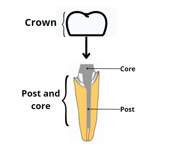 Tooth with post-and-core crown