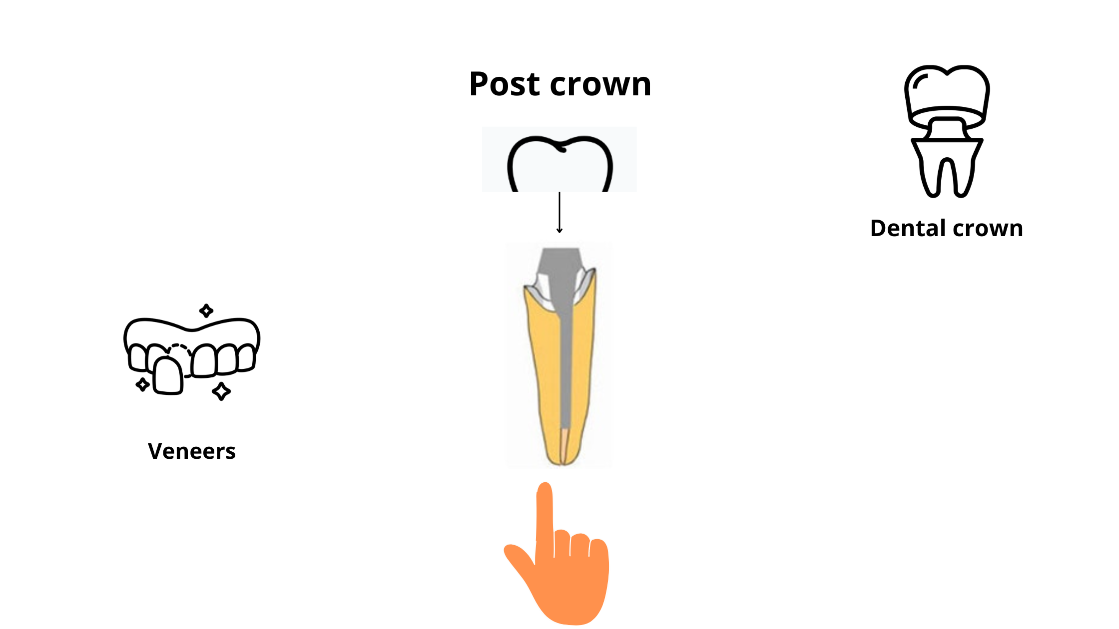 post crown