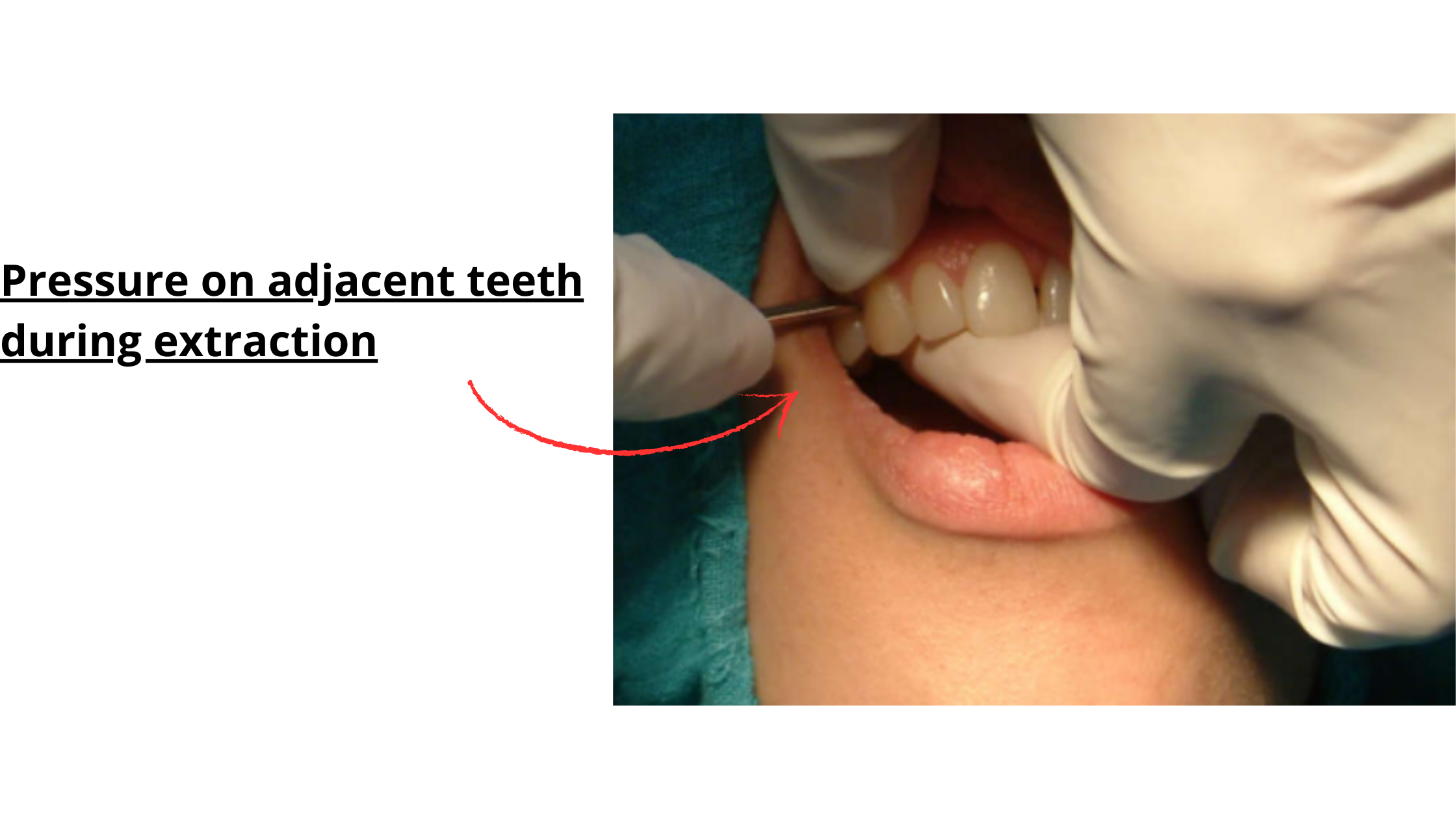 Pressure on adjacent teeth during tooth extraction