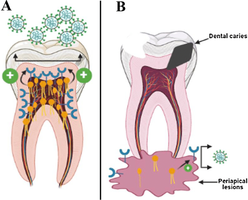 pulp infection