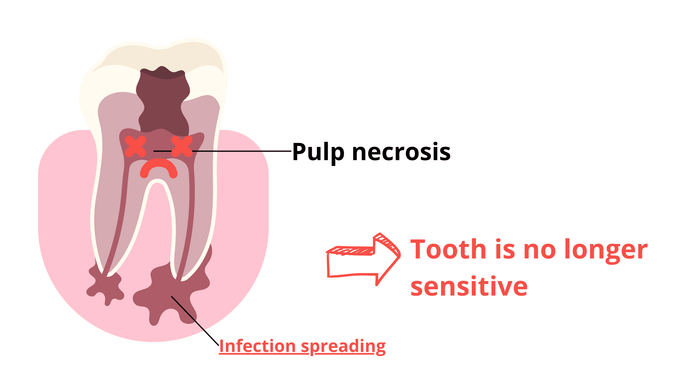 Pulpal necrosis leads to tooth insensitivity.
