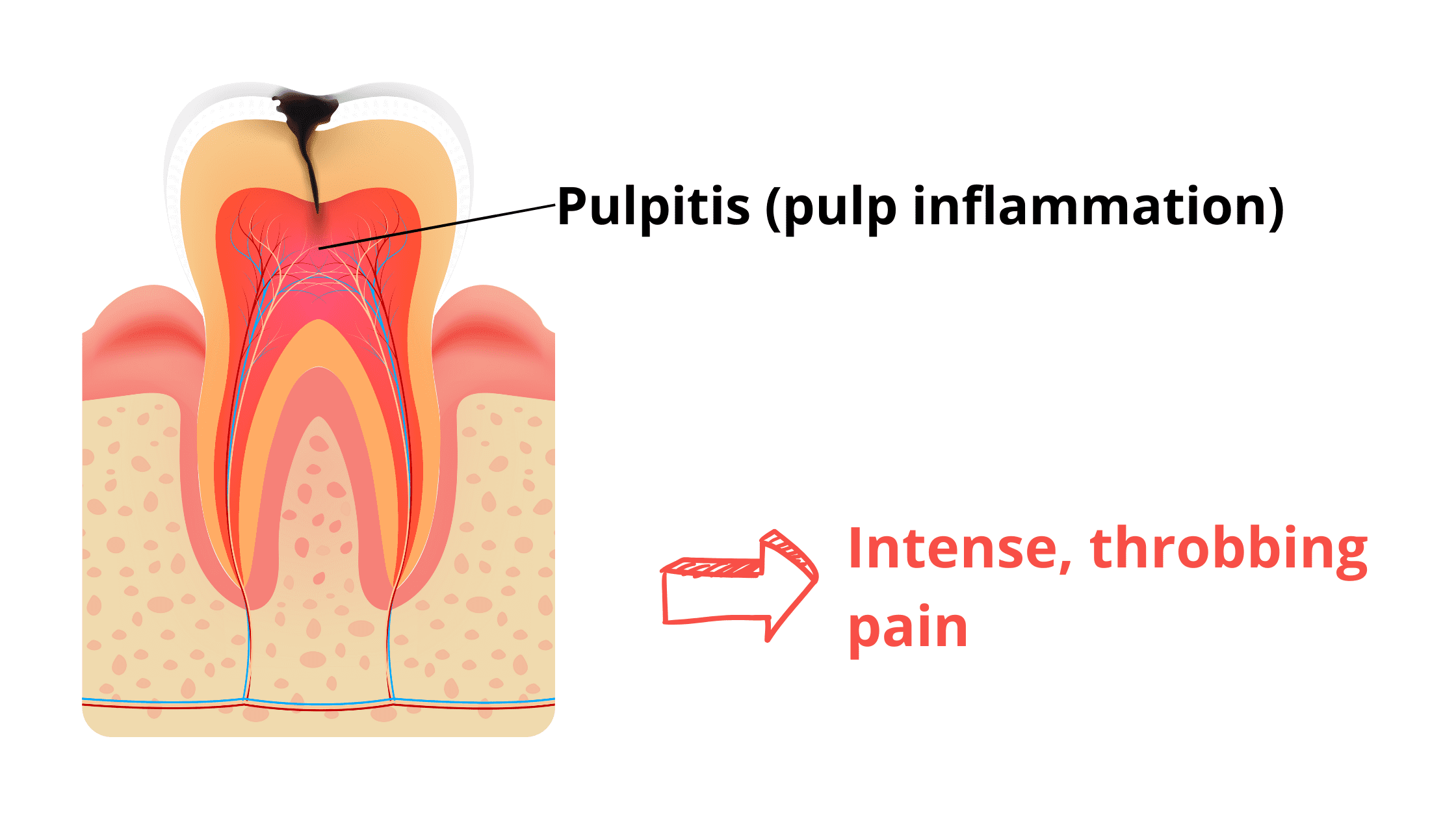Pulpitis, or inflammation of the pulp, is a painful complication when the cavity reaches the pulp.