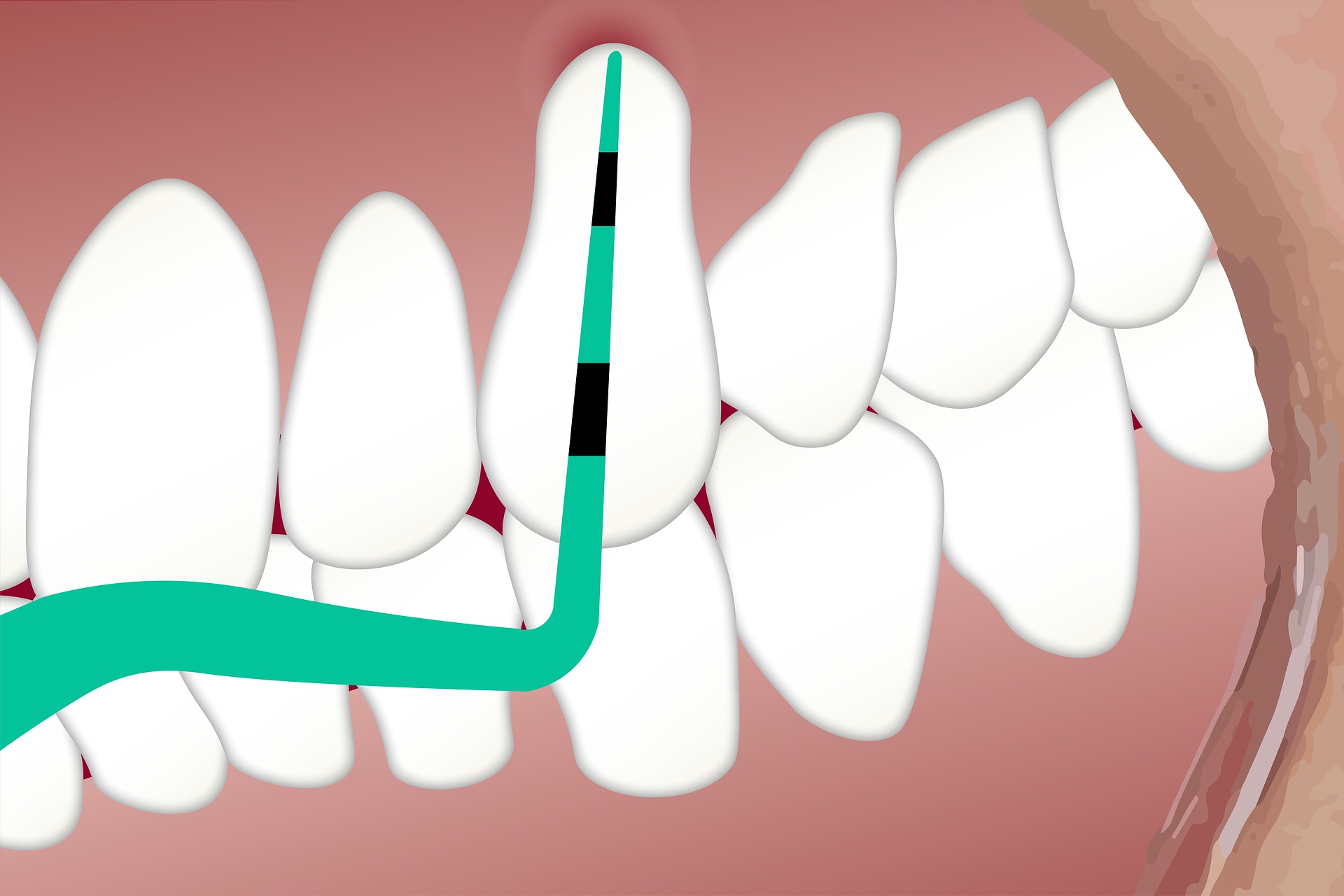 Exposed tooth root