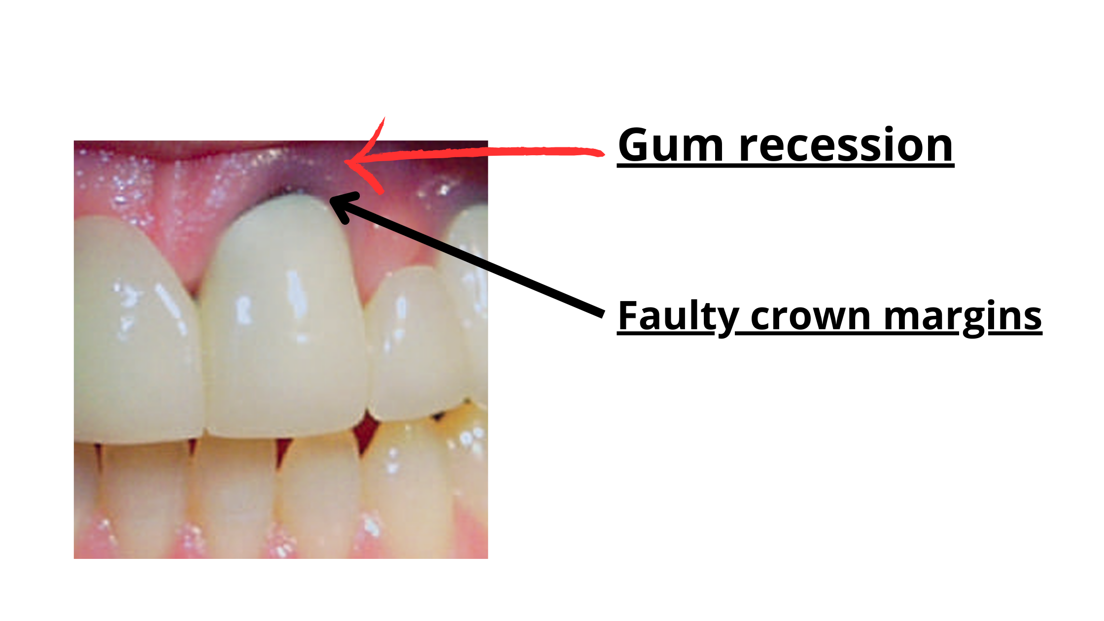 receding gums due to a crown whose margins are placed deep below the gum line