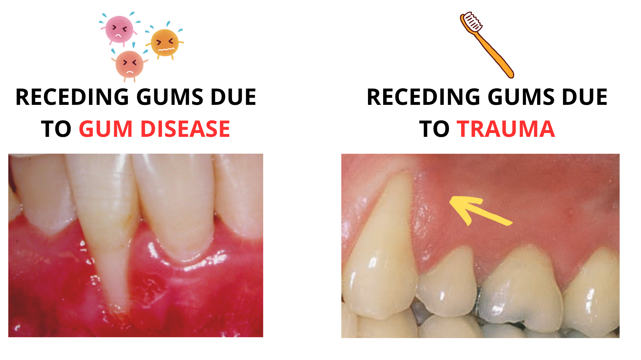 Receding gums caused by gum disease vs receding gums caused by trauma (aggressive tooth brushing)