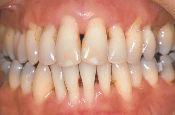 receding gums due to untreated periodontitis