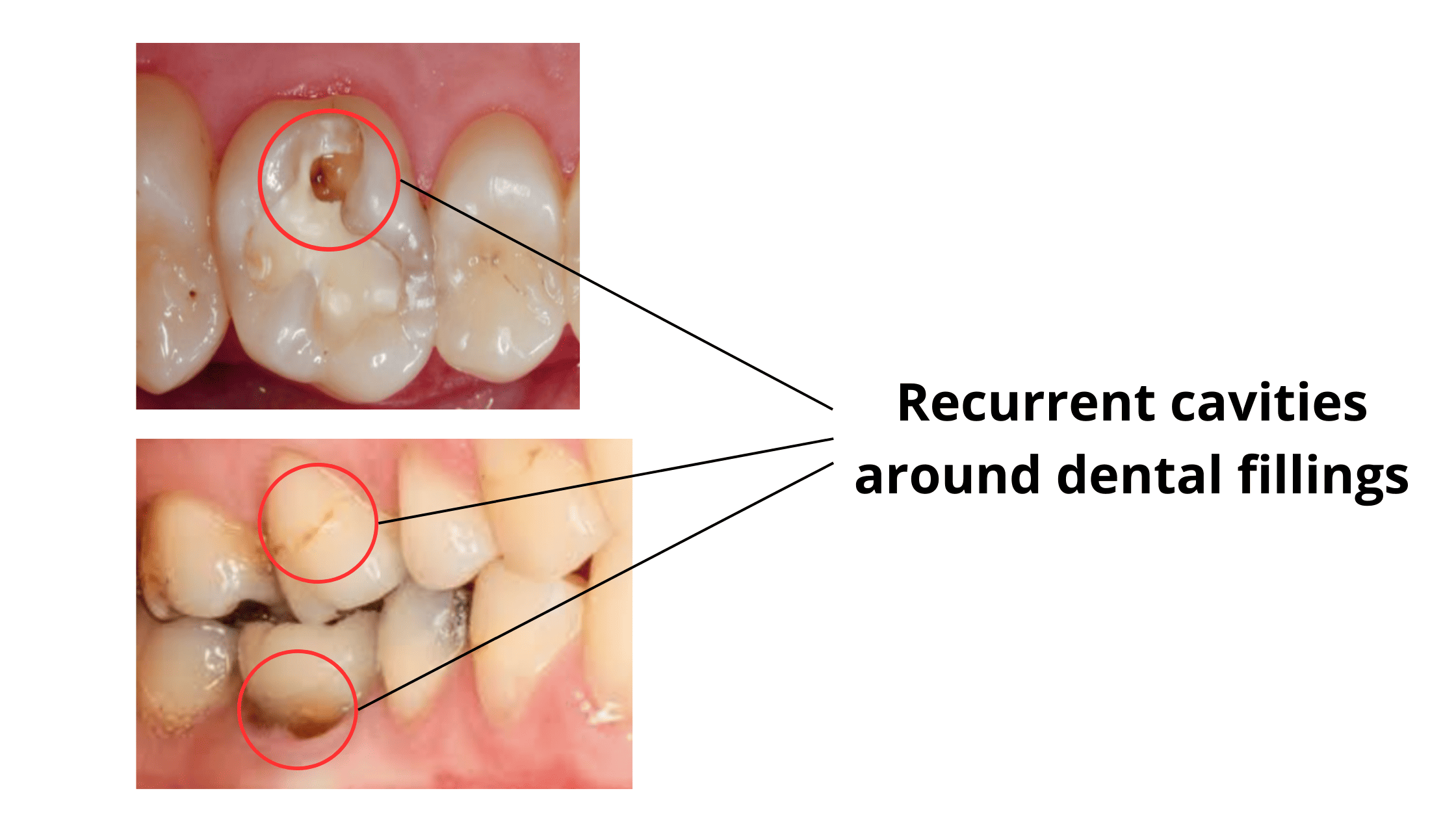 recurrent cavities under composite fillings