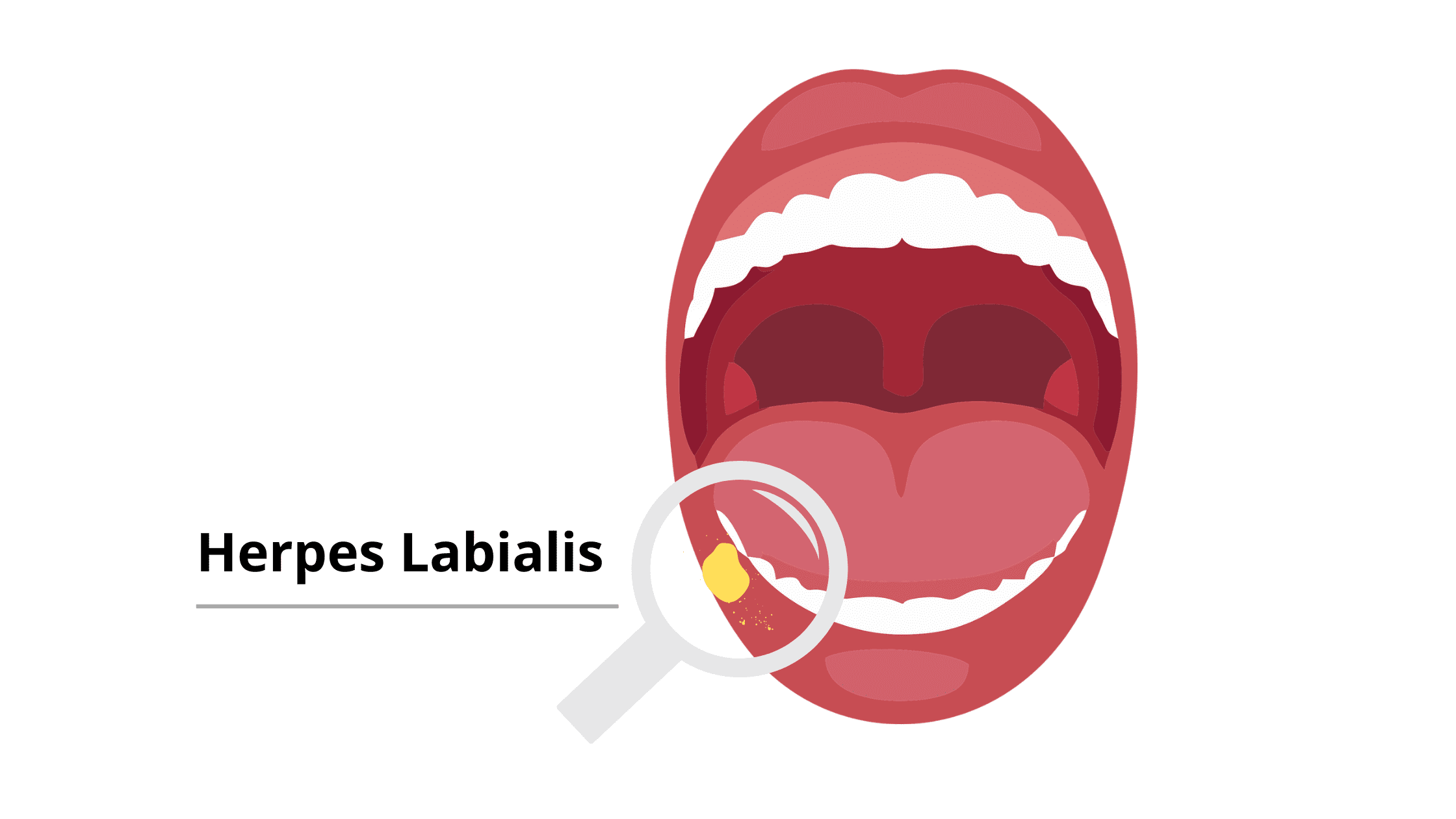 Recurrent herpes simplex infection: Herpes labialis