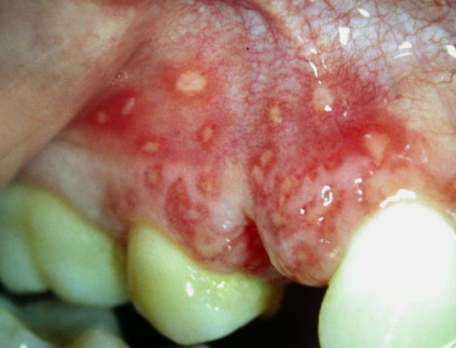 Recurrent herpes simplex infection: Multiple vesicles on the gums