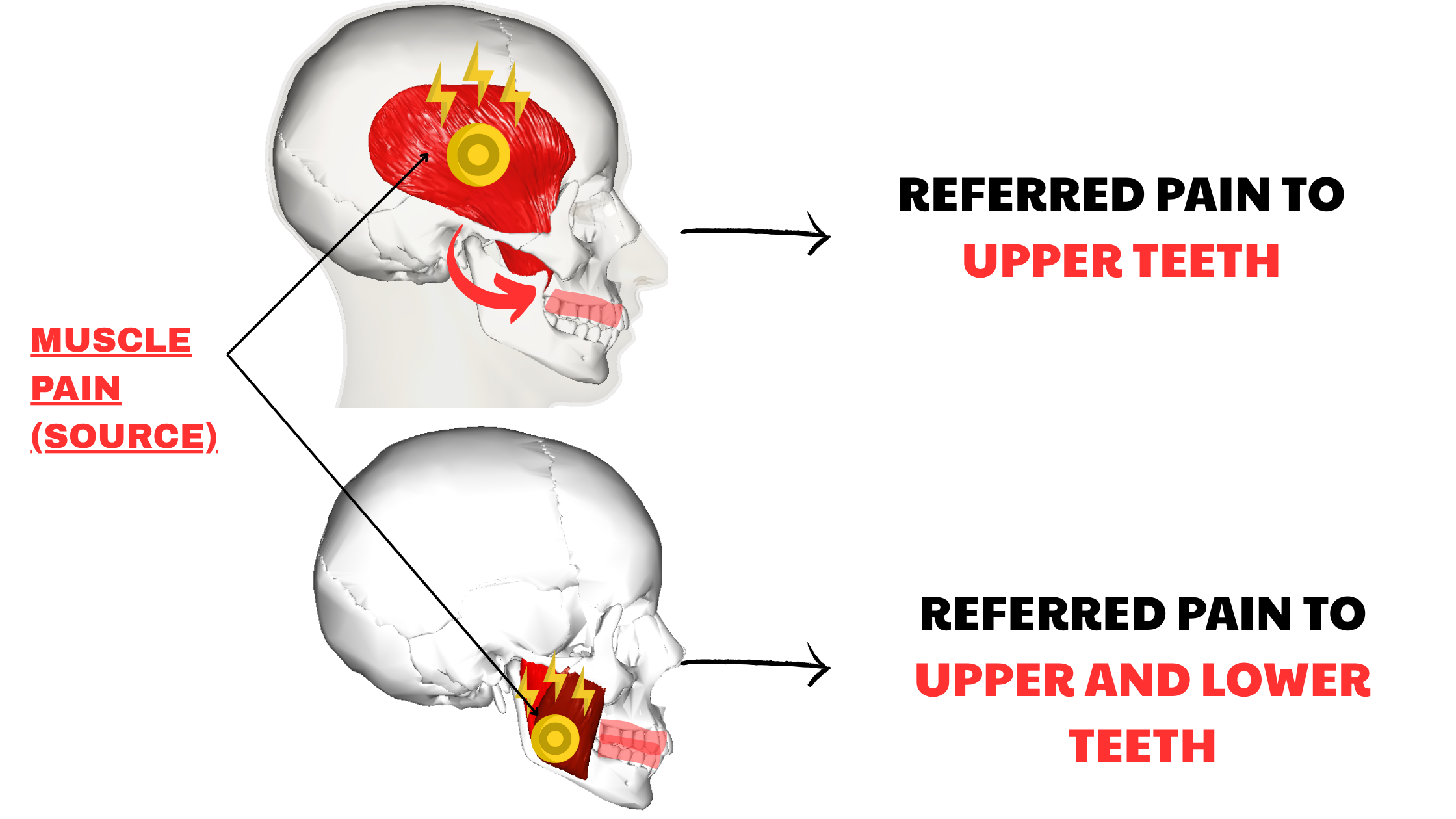 temporomandibular disorders and referred tooth pain