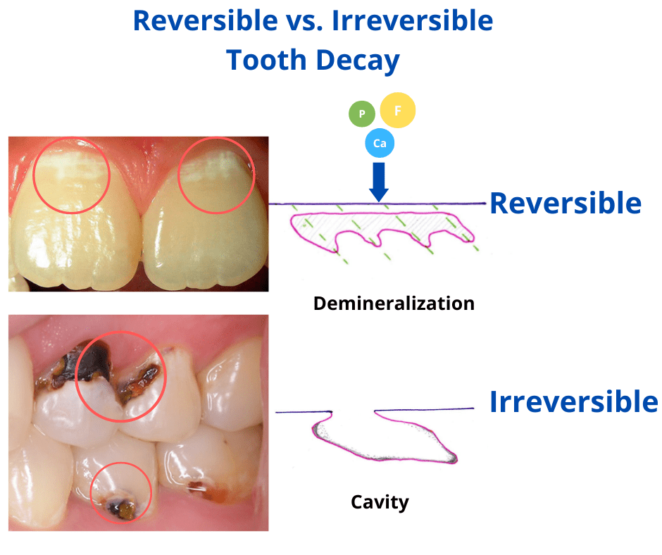 reversible vs. irreversible tooth decay