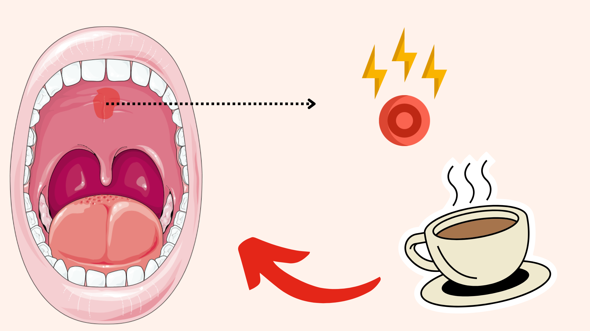 Mouth Burns to the roof of the mouth from hot coffee