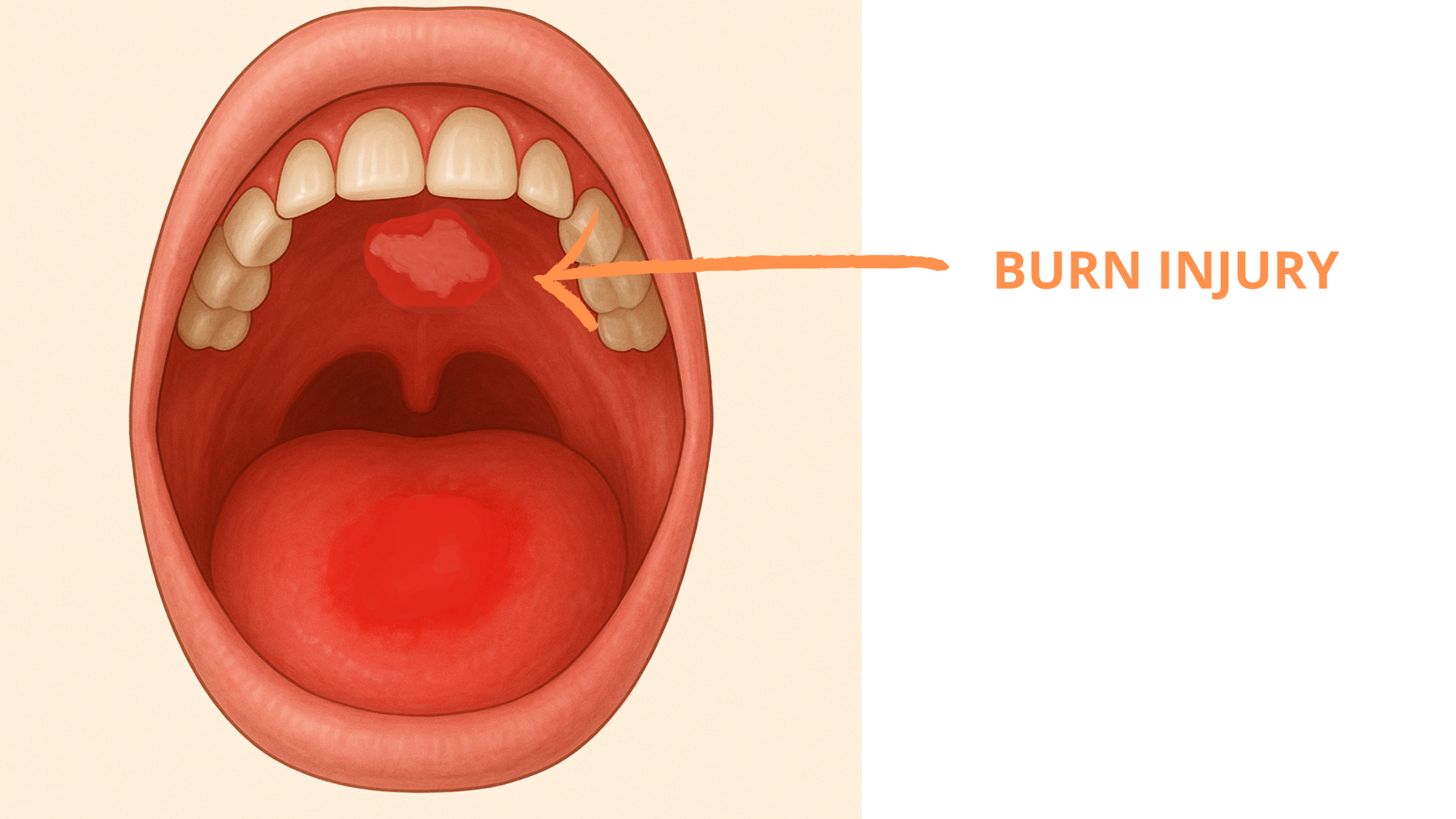 Severe palate burn: red patches with large white blister