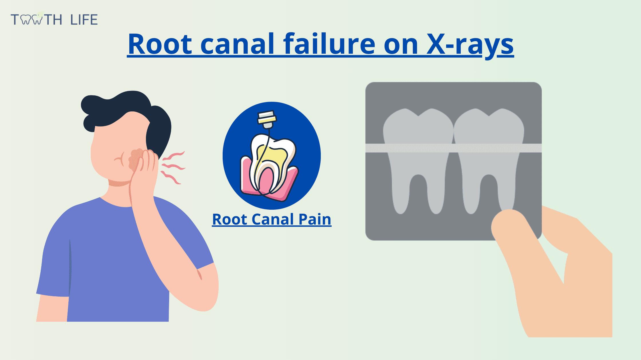 root canal failure and pain