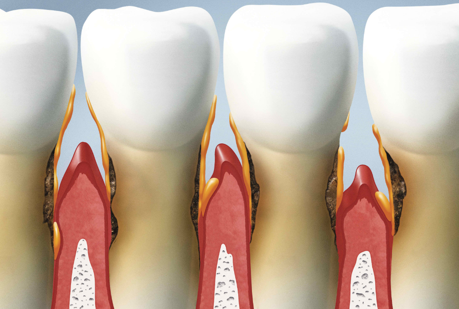 tooth decay